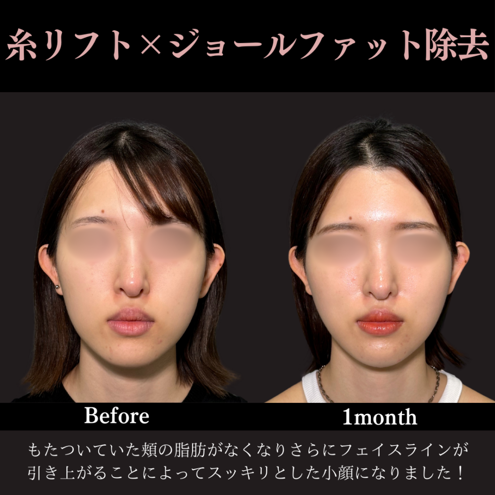 ジョールファット除去 ＋ 糸リフト