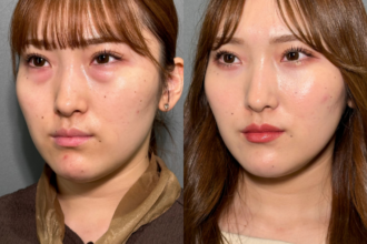 切らない目の下のクマ取り+ヒアルロン酸(目の下) 切らない目の下のクマ取り+ヒアルロン酸(目の下)