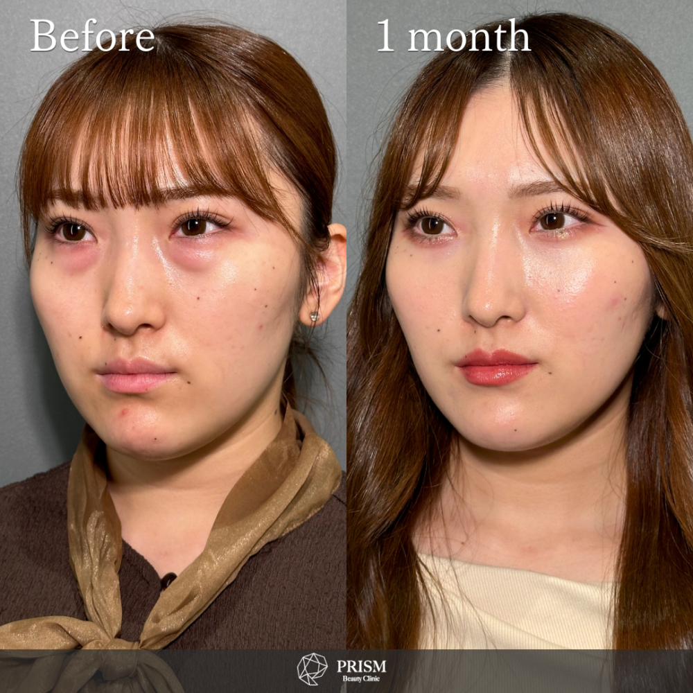 切らない目の下のクマ取り＋ヒアルロン酸（目の下）