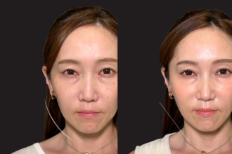 グランリフト+ ヒアルロン酸(頬) グランリフト+ ヒアルロン酸(頬)