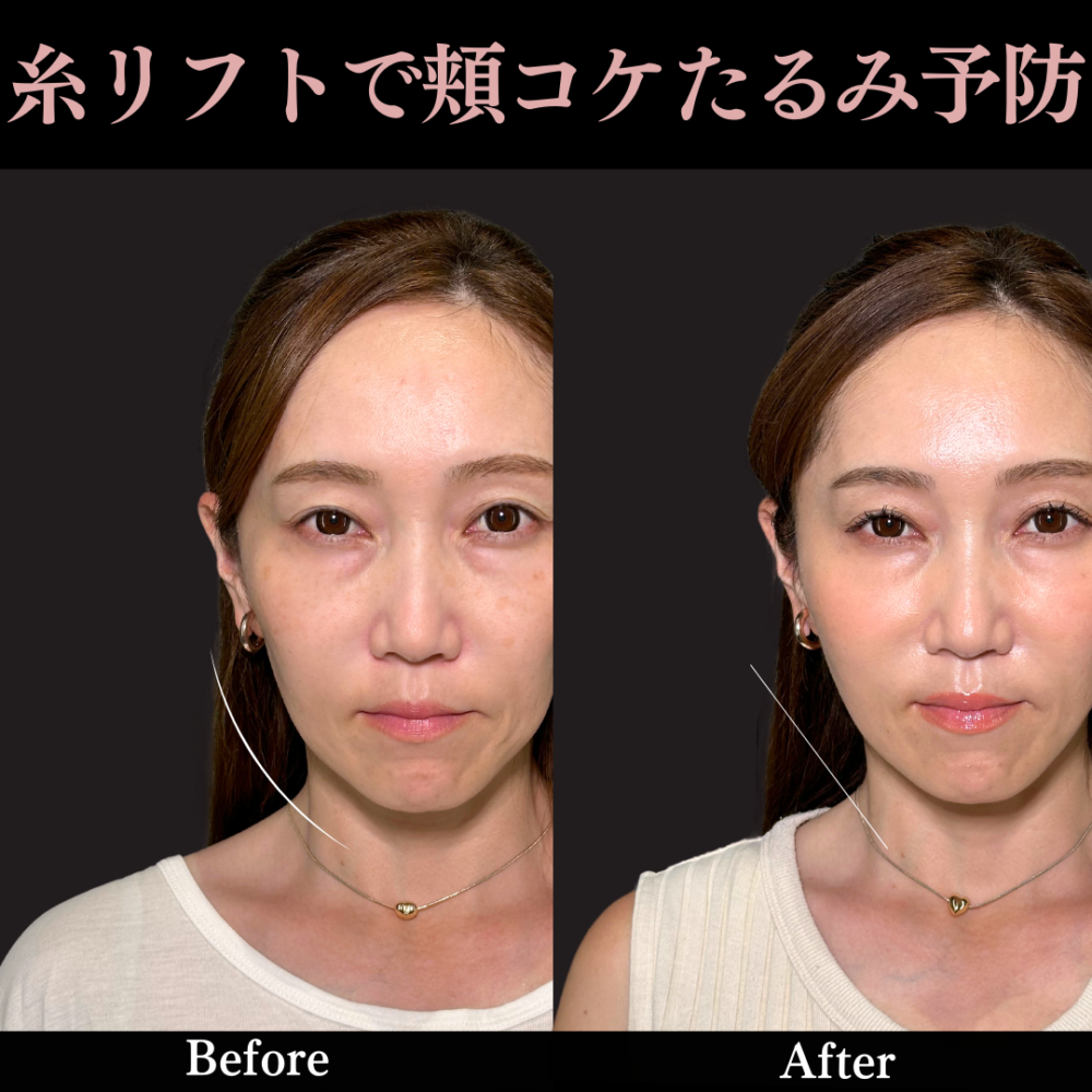 グランリフト＋ ヒアルロン酸（頬）