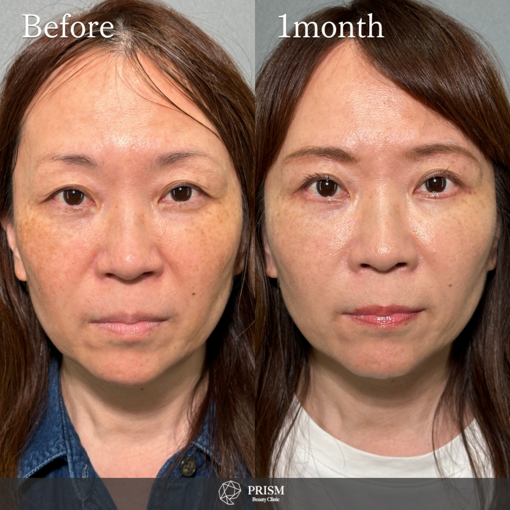 眉下リフト 眉下リフト