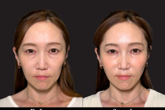 グランリフト+ ヒアルロン酸(頬) グランリフト+ ヒアルロン酸(頬)