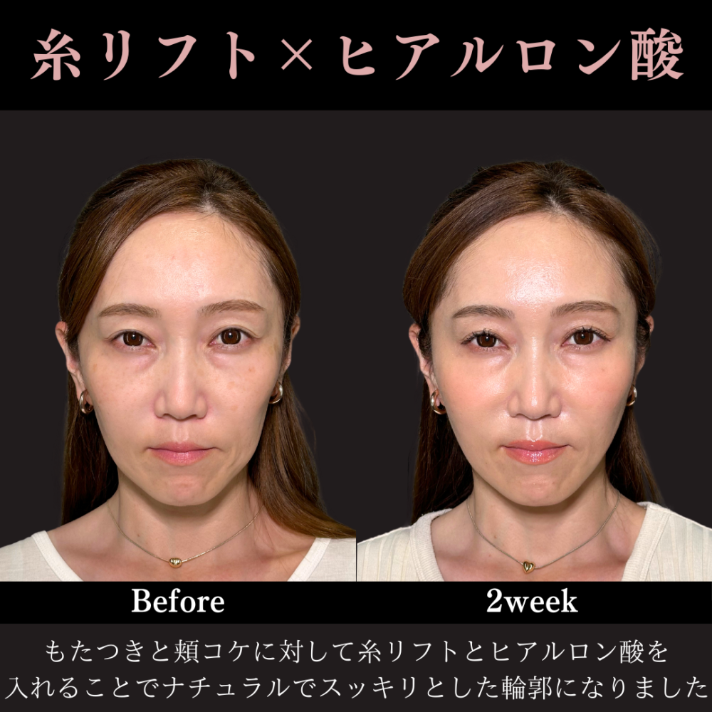 グランリフト＋ ヒアルロン酸（頬）