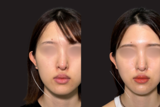 ジョールファット除去 ＋ 糸リフト