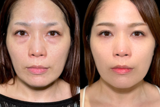 切らない目の下のクマ取り+ヒアルロン酸(目の下) 切らない目の下のクマ取り+ヒアルロン酸(目の下)