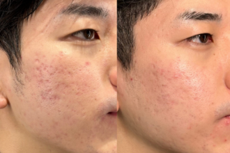 サブシジョン サブシジョン