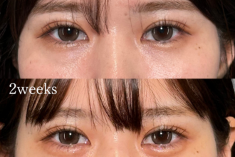 ヒアルロン酸(涙袋) ヒアルロン酸(涙袋)