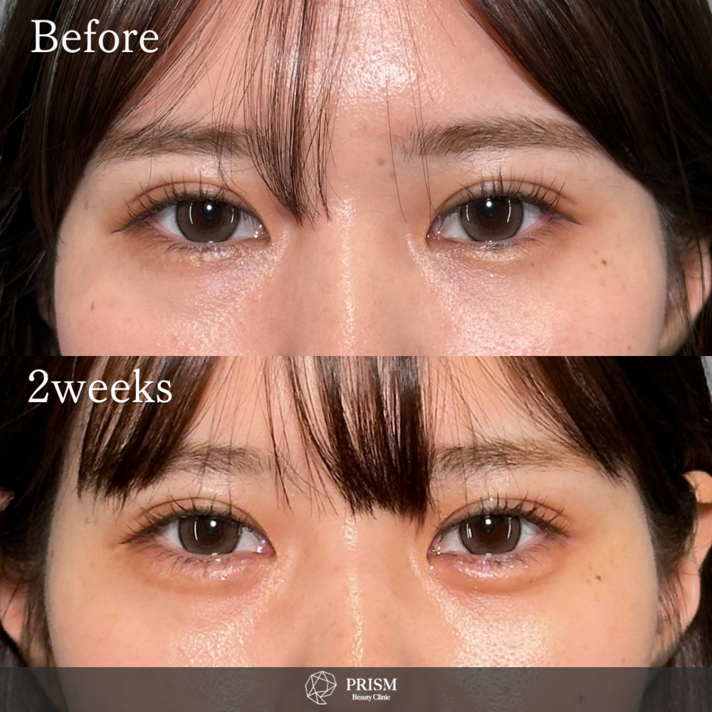 ヒアルロン酸（涙袋）