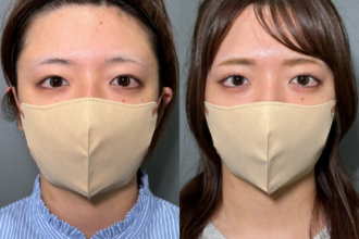 PRISM 1day二重埋没 プレミアム 線留め (自然癒着法)