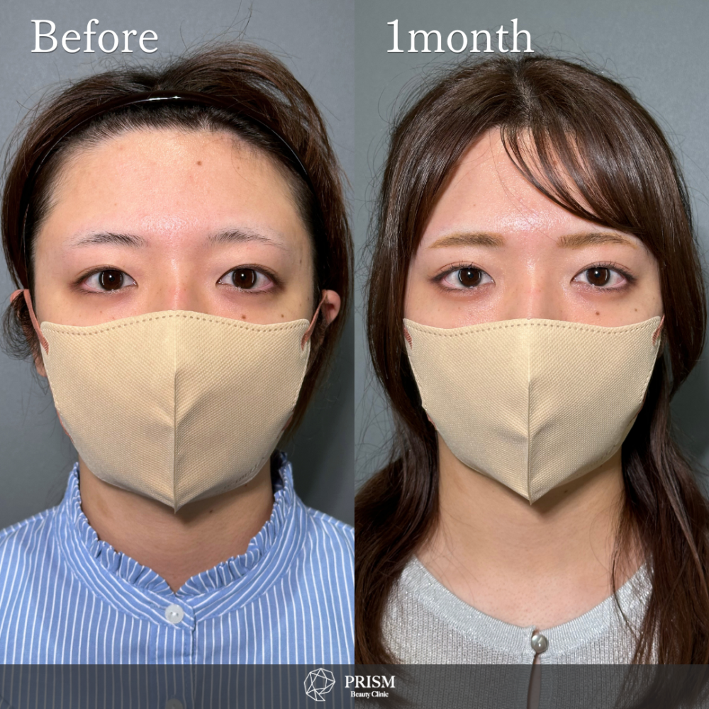 PRISM 1day二重埋没 プレミアム 線留め (自然癒着法)