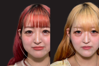 脂肪吸引クイック（頬）