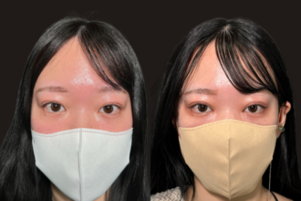 PRISM 1day二重埋没＋まぶたの脂肪取り＋目頭切開Z法