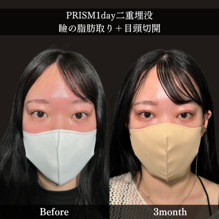 PRISM 1day二重埋没＋まぶたの脂肪取り＋目頭切開Z法