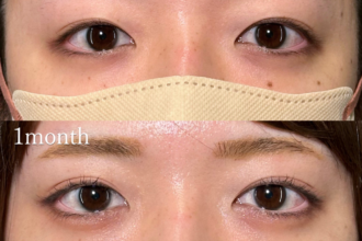 PRISM 1day二重埋没 プレミアム 線留め (自然癒着法)