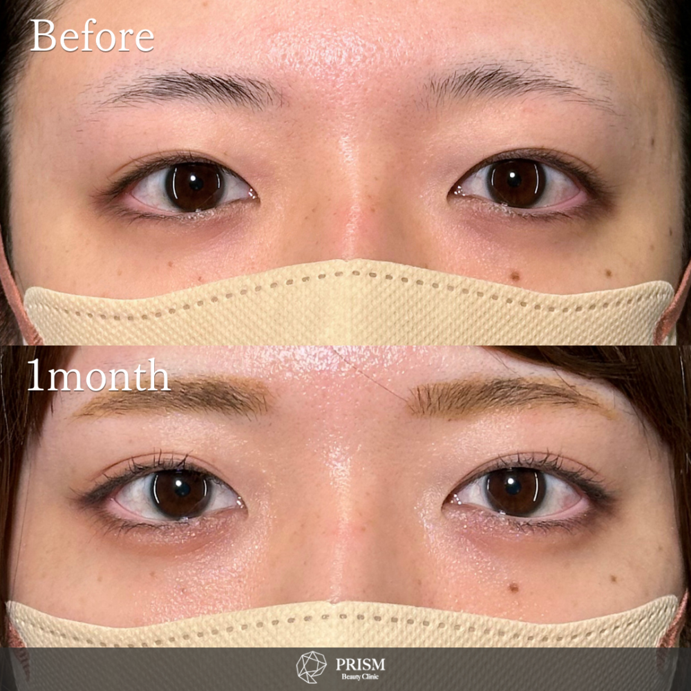 PRISM 1day二重埋没 プレミアム 線留め (自然癒着法)