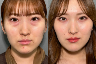 切らない目の下のクマ取り+ヒアルロン酸(目の下) 切らない目の下のクマ取り+ヒアルロン酸(目の下)