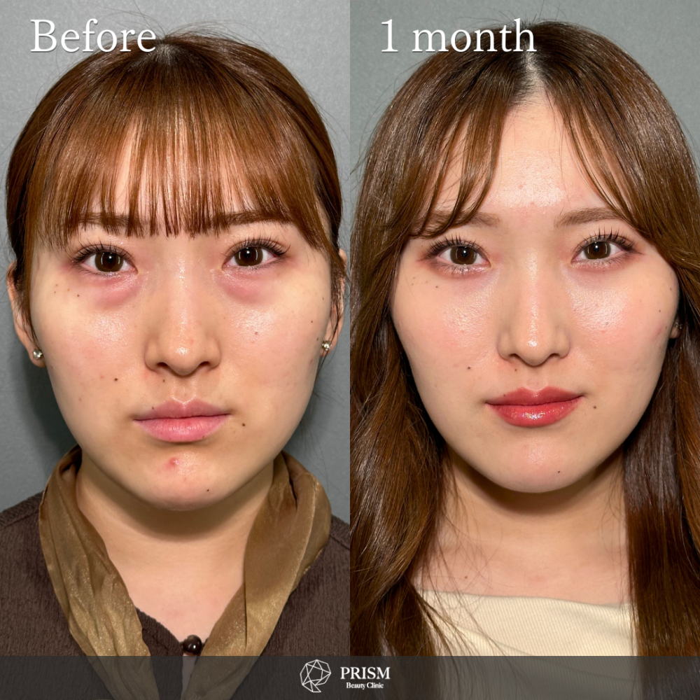 切らない目の下のクマ取り＋ヒアルロン酸（目の下）