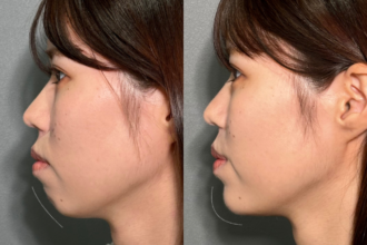 ヒアルロン酸(顎、涙袋) ヒアルロン酸(顎、涙袋)