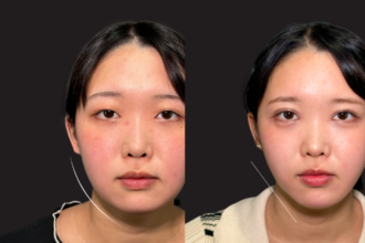 脂肪吸引プレミアム（頬＋顎下）＋ バッカルファット除去