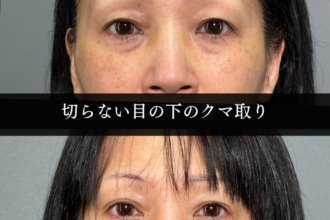 切らない目の下のクマ取り（経結膜脱脂術）