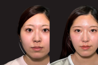 脂肪吸引クイック（頬・顎下） ＋ エラボトックス