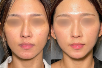 美人レーザー（MIINレーザー) 【スポット シミ取り放題】