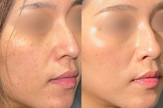 美人レーザー（MIINレーザー) 【スポット シミ取り放題】