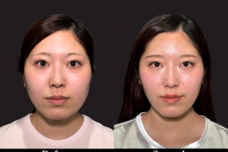 脂肪吸引クイック（頬・顎下） ＋ エラボトックス