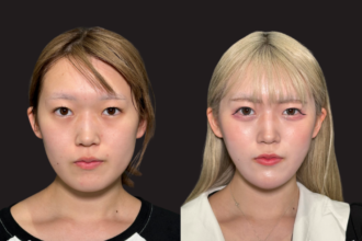 脂肪吸引（頬・顎下）+ 糸リフト + あご先リフト + エラボトックス