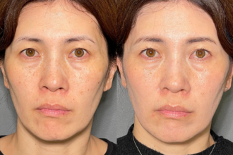 美人レーザー(MIINレーザー) 【トーニング】【コラーゲントーニング】【スポット シミ取り放題】