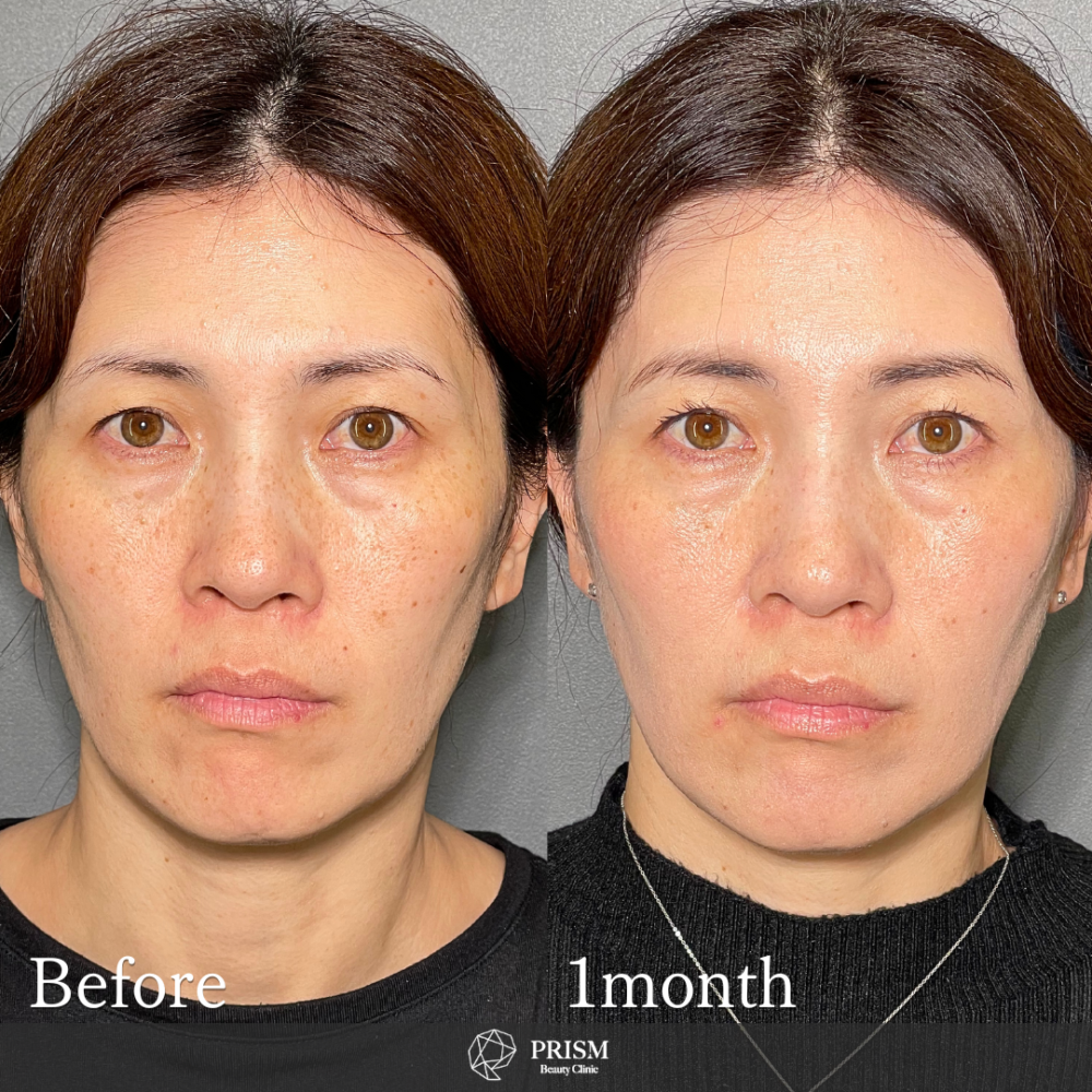 美人レーザー(MIINレーザー) 【トーニング】【コラーゲントーニング】【スポット シミ取り放題】