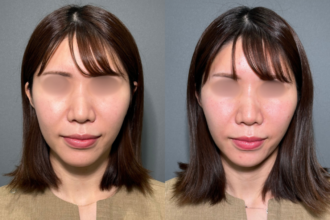 ボトックス注射（ほうれい線）