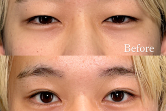 PRISM 1day二重埋没 プレミアム 線留め (自然癒着法)