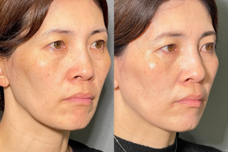 美人レーザー(MIINレーザー) 【トーニング】【コラーゲントーニング】【スポット シミ取り放題】