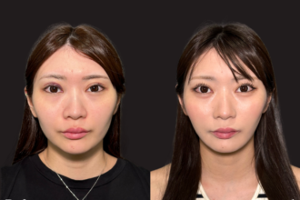 脂肪吸引プレミアム(頬・顎下) 脂肪吸引プレミアム(頬・顎下)