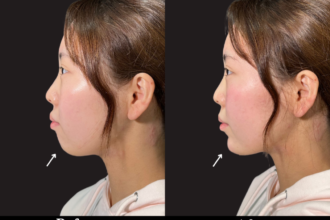 あご先リフト+ ヒアルロン酸(顎) あご先リフト+ ヒアルロン酸(顎)