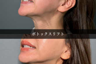 ボトックスリフト（広頚筋ボトックス）