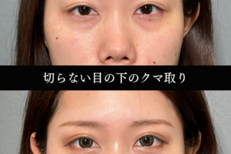 切らない目の下のクマ取り（経結膜脱脂術）