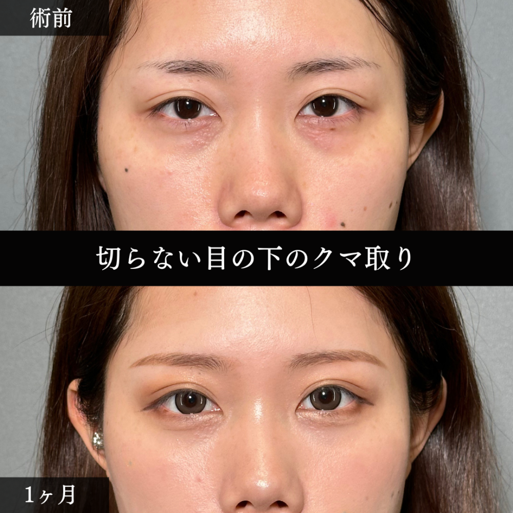切らない目の下のクマ取り（経結膜脱脂術）
