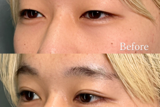 PRISM 1day二重埋没 プレミアム 線留め (自然癒着法)