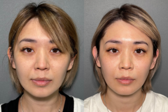 ヒアルロン酸注射（ほうれい線）