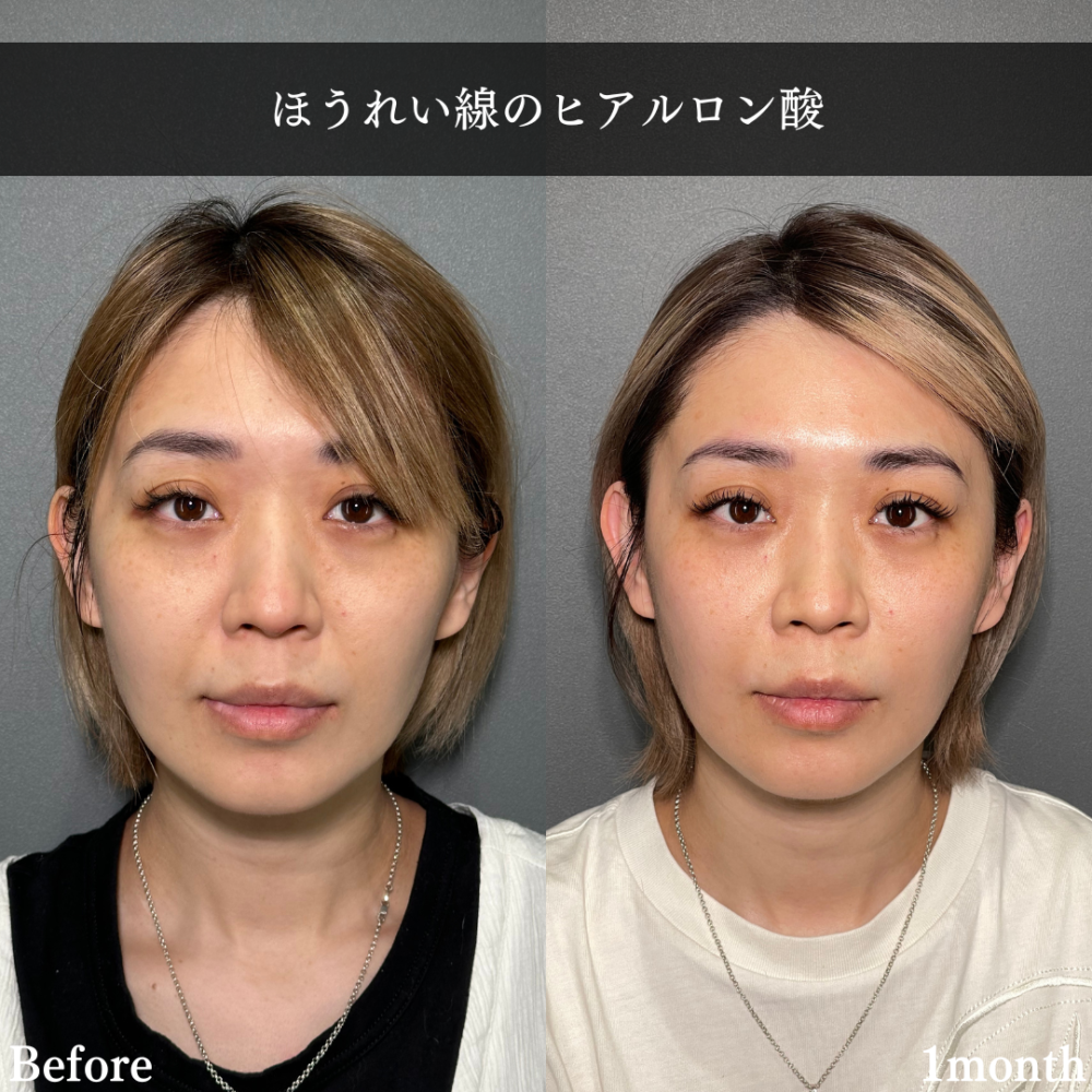 解剖から学ぶヒアルロン酸注入療法 美容 Amazon.co.jp: 解剖から学ぶ ヒアルロン酸注入療法 : 古山登隆