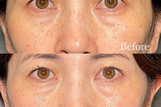 美人レーザー(MIINレーザー) 【トーニング】【コラーゲントーニング】【スポット シミ取り放題】