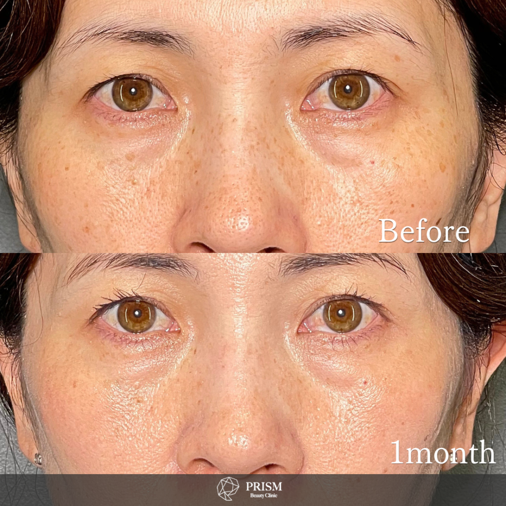 美人レーザー(MIINレーザー) 【トーニング】【コラーゲントーニング】【スポット シミ取り放題】