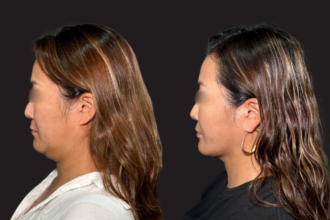 脂肪吸引プレミアム(頬・顎下)+ 糸リフト 脂肪吸引プレミアム(頬・顎下)+ 糸リフト