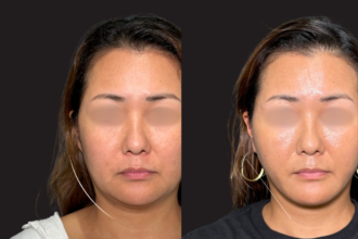 脂肪吸引プレミアム(頬・顎下)+ 糸リフト 脂肪吸引プレミアム(頬・顎下)+ 糸リフト