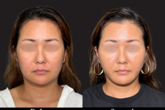 脂肪吸引プレミアム(頬・顎下)+ 糸リフト 脂肪吸引プレミアム(頬・顎下)+ 糸リフト