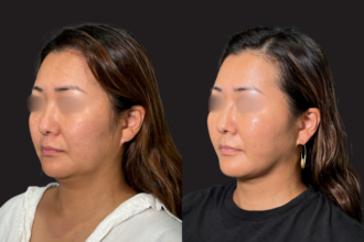 脂肪吸引プレミアム(頬・顎下)+ 糸リフト 脂肪吸引プレミアム(頬・顎下)+ 糸リフト