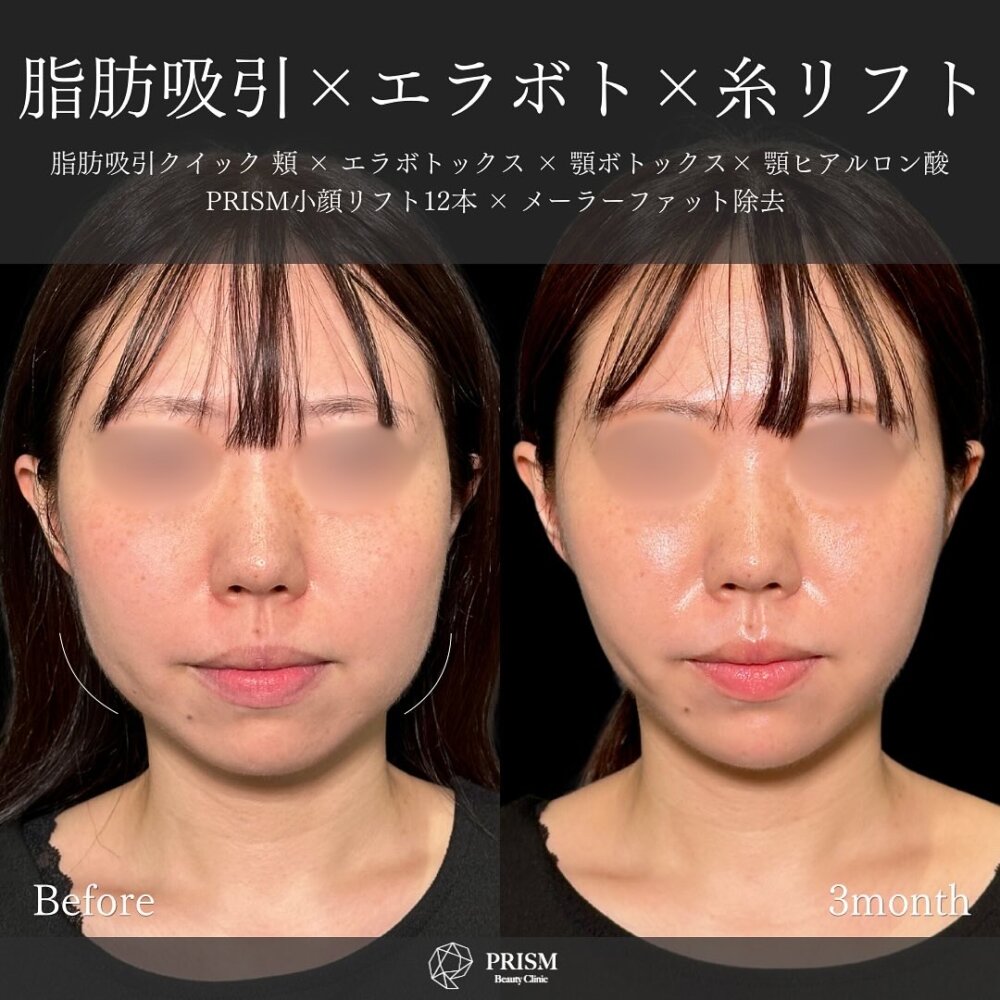 小顔リフトアップ・輪郭形成 < PRISM Beauty Clinic プリズムビューティークリニック 東京 町田・神奈川  相模原の美容外科・美容整形・美容皮膚科クリニック 小顔整形のプロ